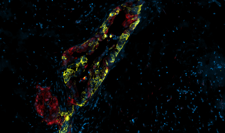 Drivers of tumoral heterogeneity: Tumor-TME-Interplay